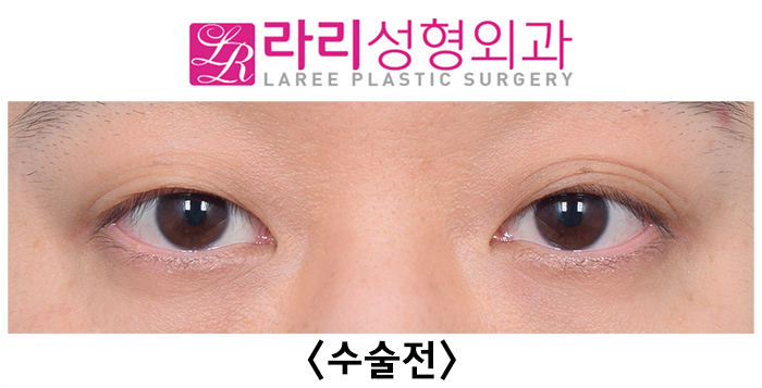 [Lari Plastic Surgery] Surgery Before-and-After Photos for Removing Multiple Eyelid Folds That Are Hard to Leave Alone image 1