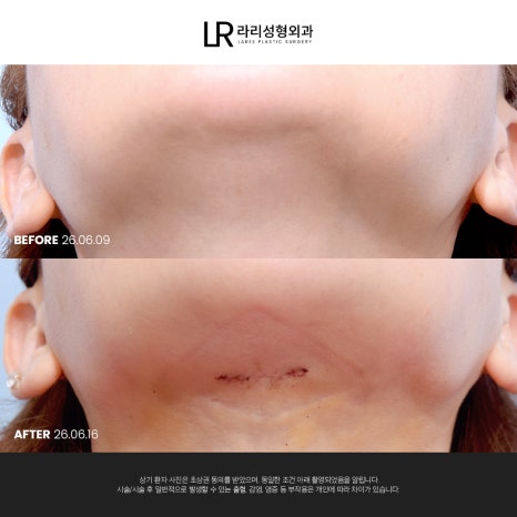[라리성형외과] 이중턱 지방 흡입만으로는 아쉬운 얼굴 라인, 이중턱 근육 묶기도 같이 하면 효과가 두 배! 관련 이미지 9