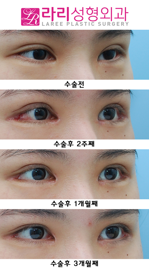 눈재수술  원인을 찾아서 ! (쌍재, 앞재, 뒤재로 해결) 관련 이미지 2