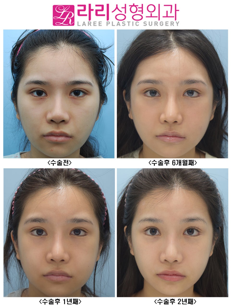 [Lari Plastic Surgery] Effective and Natural Canthoplasty for Lowering the Outer Eye Corner Without Lower Canthoplasty Surgery: Before-and-After Photos Up to 2 Years image 1