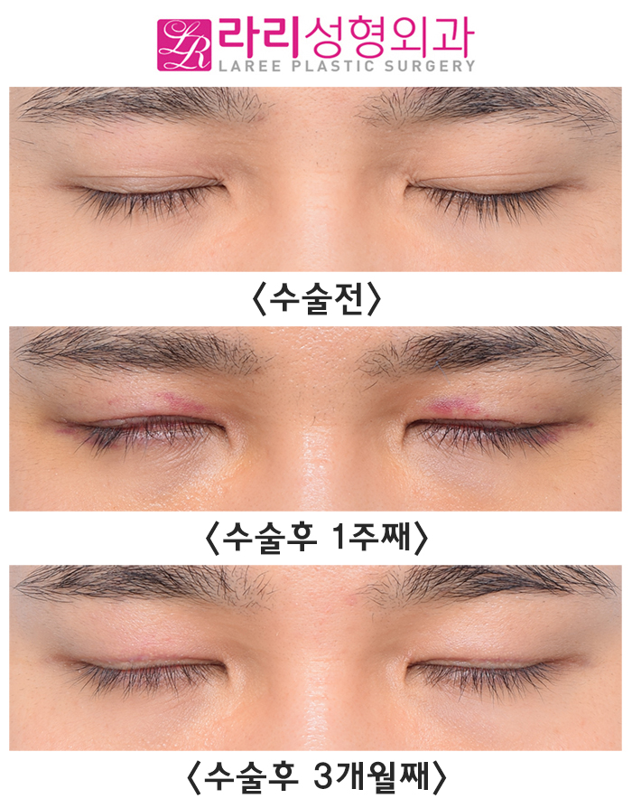 [라리성형외과] 자연쌍꺼풀없애기 수술 전후 사진 회복 기간 짝눈 교정 관련 이미지 4