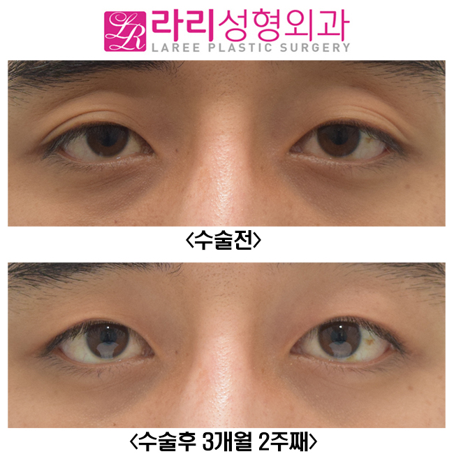 [라리성형외과] 쌍꺼풀 없애는 수술 받으면 쌍꺼풀 없애기 가능한가요..? 관련 이미지 1