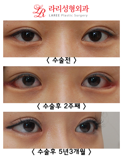 8-Year Long-Term Follow-Up vs. 2-Week Short-Term Follow-Up in the Same Patient (Lateral Canthoplasty & Revision Lateral Canthoplasty) image 2