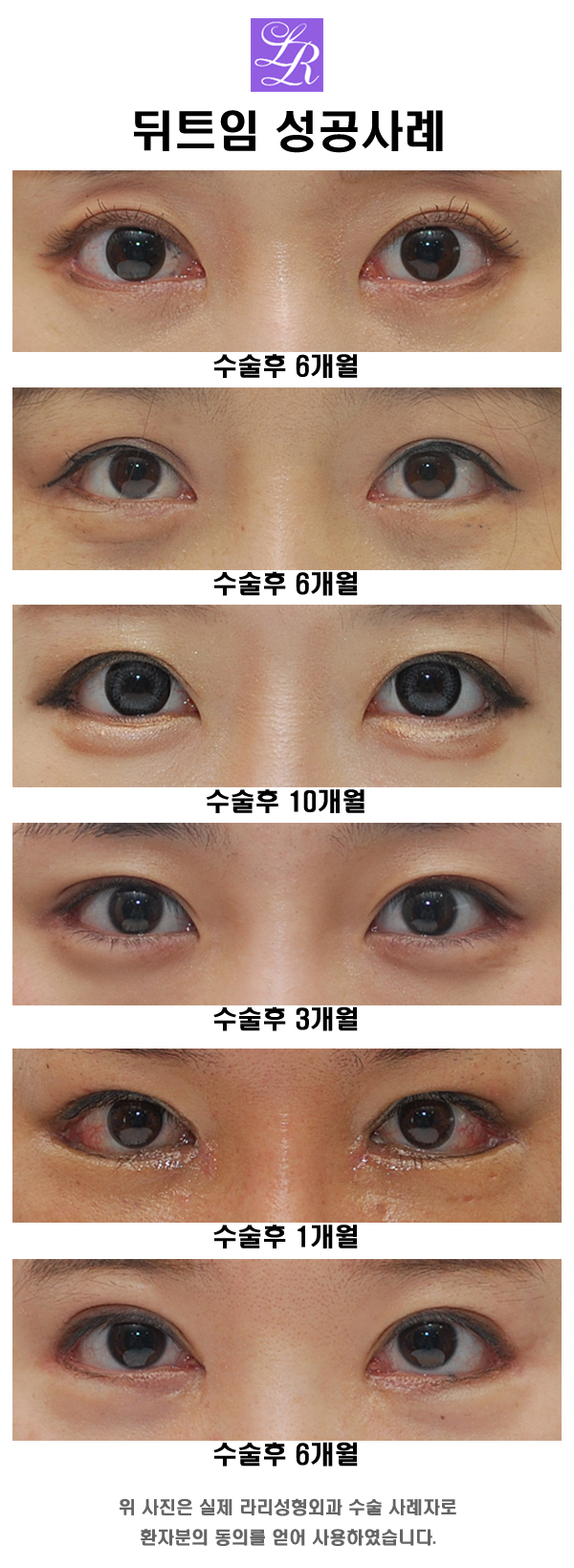 뒤트임수술, 부작용이 많은 수술일까? 관련 이미지 3