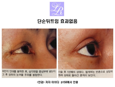 Revision of Lateral Canthoplasty - Fixation Method, Scar Correction, Recovery, and More image 2