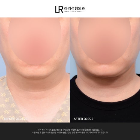 [라리성형외과] 이중턱 지방 흡입만으로는 아쉬운 얼굴 라인, 이중턱 근육 묶기도 같이 하면 효과가 두 배! 관련 이미지 7