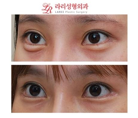 눈꼬리내리기뒤트임/뒷트임 재수술 전후사진 관련 이미지 3