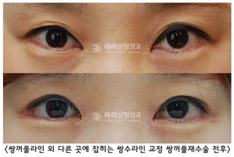 [라리성형외과] 쌍꺼풀수술 그리고 쌍꺼풀재수술 , 성공하려면 어디서 해야 할까요 !? 관련 이미지 4