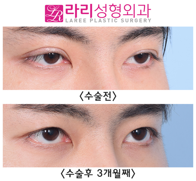 [라리성형외과] 일타쌍피, 한 번의 수술로 쌍꺼풀없애는수술과 눈매교정을 동시에 관련 이미지 3