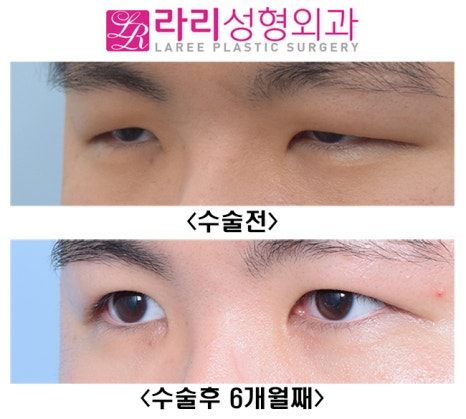 [Lari Plastic Surgery] The Effect of Double Eyelid Incision Ptosis Correction That Opens Unopened Eyes Wide image 5