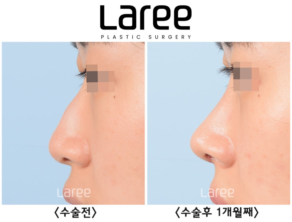 [Lari Plastic Surgery] Hump Nose Surgery Is Performed Naturally Without Implants. (No Implants, Septal Cartilage) image 4