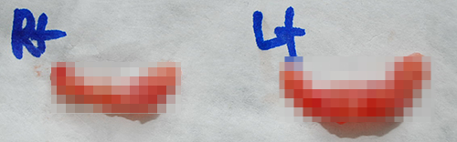 [Laree Plastic Surgery] Aegyo Filler? Permanent Filler? No More Foreign Materials image 3