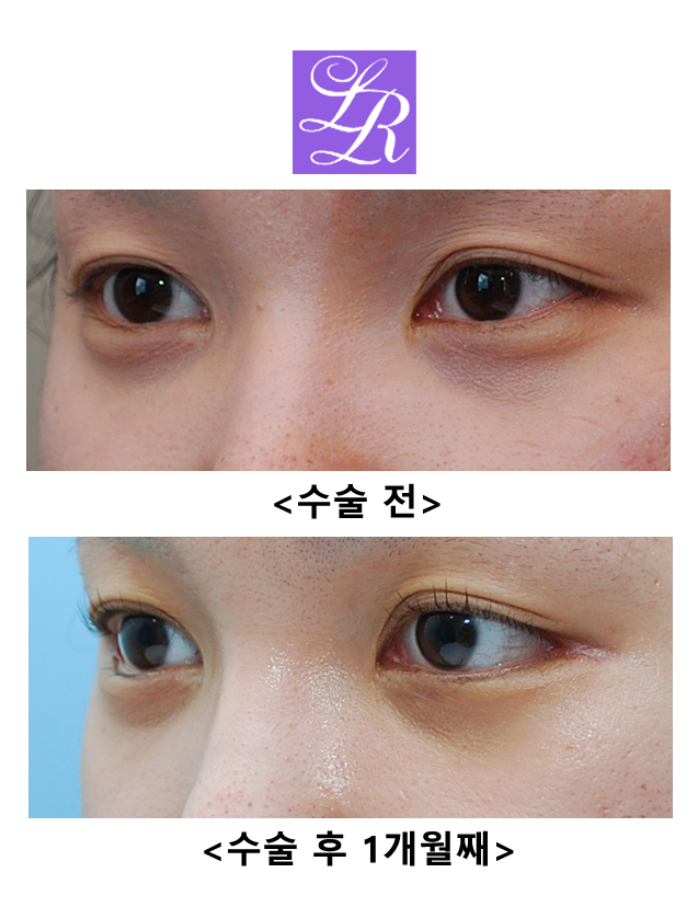 Before and After Lateral Canthoplasty (Close-up Photos - Scar at the Outer Corner Visible!) image 2