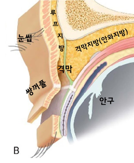 [라리성형외과] 쌍꺼풀없애기 수술 눈안감김(토안)의 원인이 정말 피부절제 때문일까? - 무절제쌍꺼풀없애기 관련 이미지 4