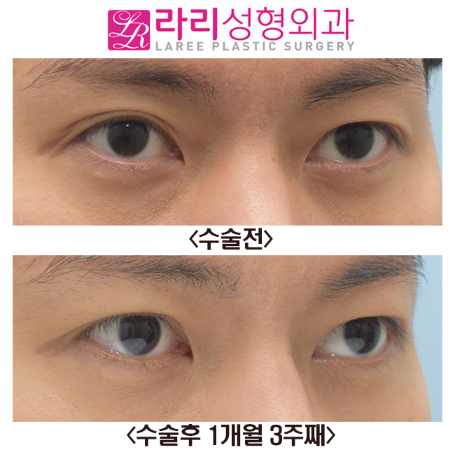 [Rari Plastic Surgery] Before and After Right Non-incisional Double Eyelid Reoperation image 5
