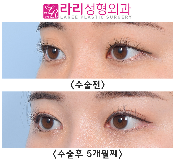 [Rari Plastic Surgery] First Eye Surgery (Non-incisional eyelid correction, epicanthoplasty, canthoplasty) Before-and-After Photos image 2