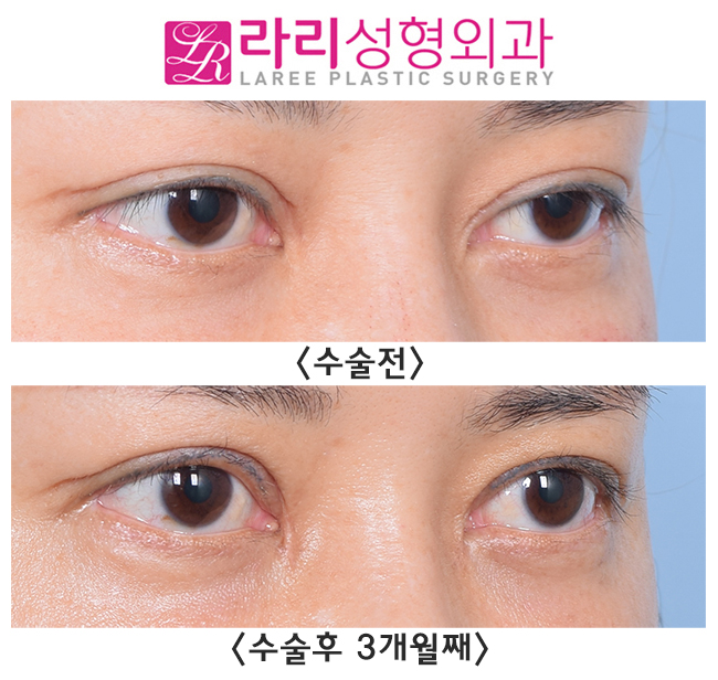 [Lari Plastic Surgery] Thick out-line double eyelids are best treated with double-eyelid revision surgery to lower the line, along with epicanthoplasty restoration!! image 2
