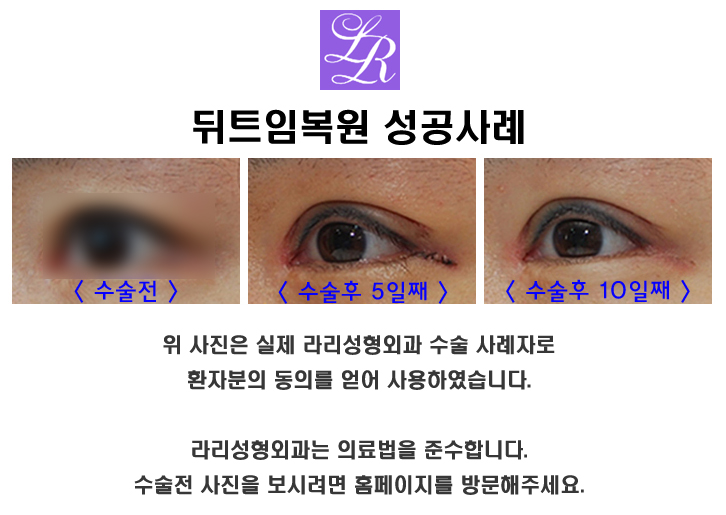 눈이 작아지지 않는 뒤트임재수술 관련 이미지 2