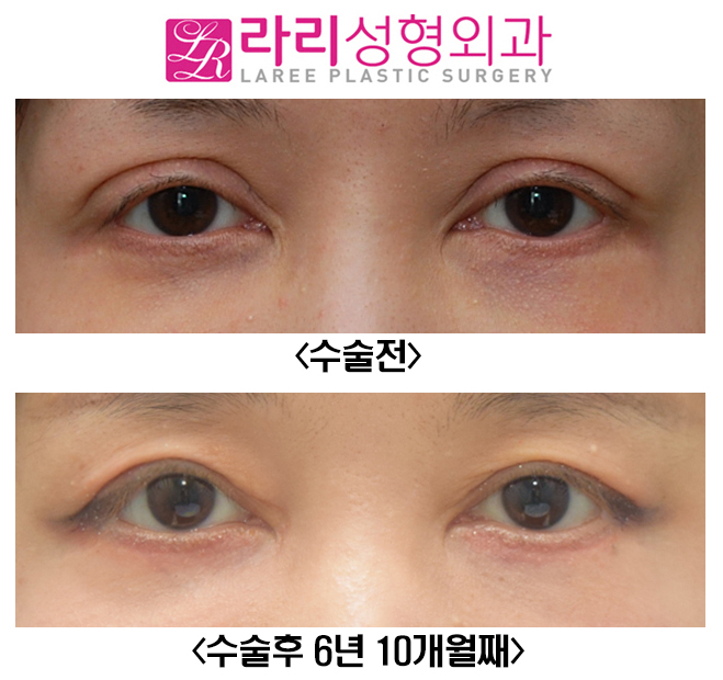 [라리성형외과] 쌍꺼풀재수술 6년 이상 장기경과 관련 이미지 1