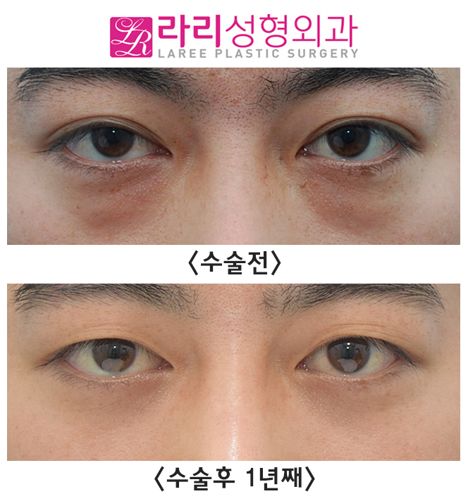 [Lari Plastic Surgery] Analysis of the Before-and-After Course of Non-Incisional Double Eyelid Removal Surgery, Which Is Effective but Has Weaknesses image 5