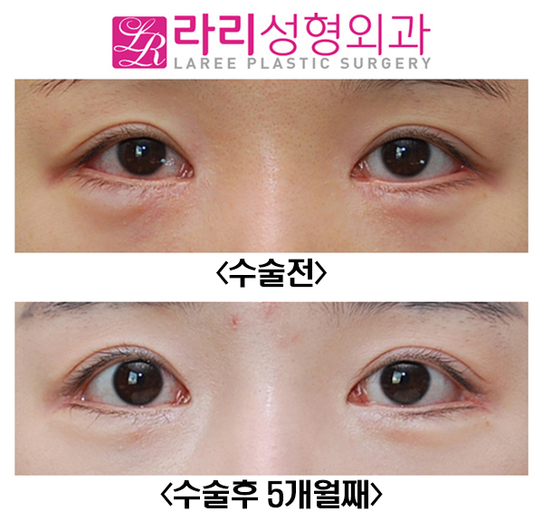 [Lari Plastic Surgery] Full Non-Incision Eye Correction, Effects and Before-and-After Photos (Different from Double Eyelid Surgery) image 3
