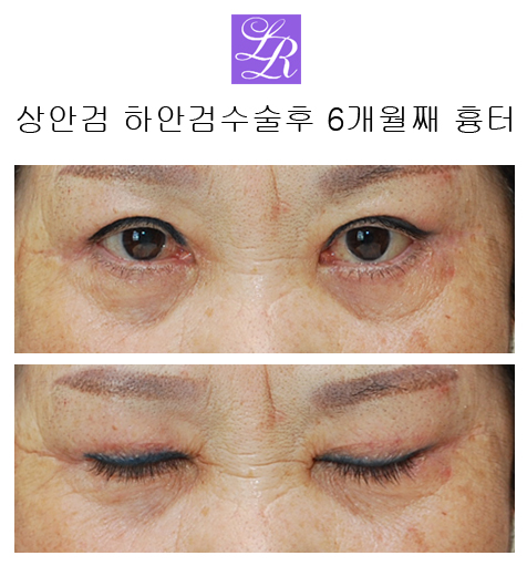 상안검수술, 하안검수술- 수술전후, 경과 궁금쓰 관련 이미지 3