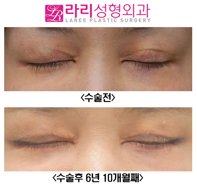 [라리성형외과] 쌍꺼풀재수술 6년 이상 장기경과 관련 이미지 2