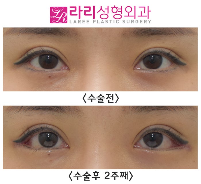 [라리성형외과] 뒤트임수술, 결막부종이 없는 경우 단기경과 (수술 전후 2주째) 관련 이미지 3