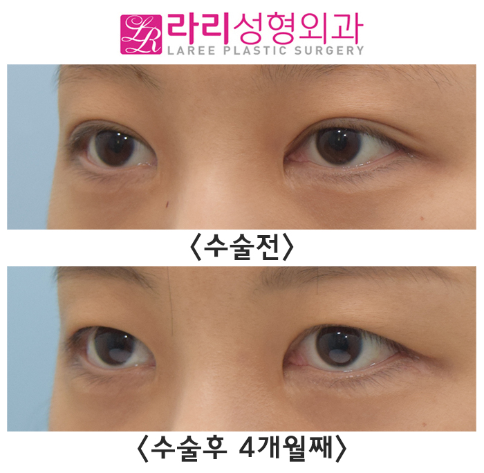 [라리성형외과] 쌍꺼풀없애는수술이 필요한 기준이 있을까? 관련 이미지 3