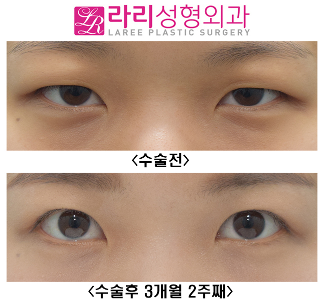[라리성형외과] 여자도 무쌍눈매교정이 어울릴까? 관련 이미지 1
