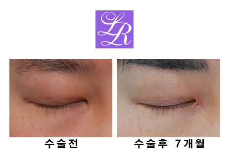 Can Epicanthoplasty Improve Facial Impression? Mongolian Fold Hook Correction image 2