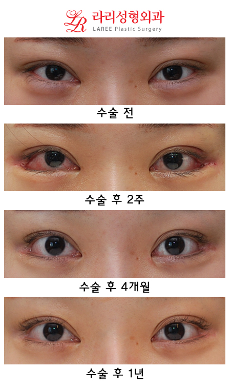뒤트임재수술 처음과는 다른 뒷트임 후기 관련 이미지 1