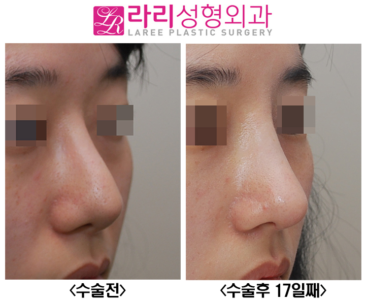 [라리성형외과] 꺾인 콧대 낮은 코끝 살리는 코재수술 관련 이미지 2