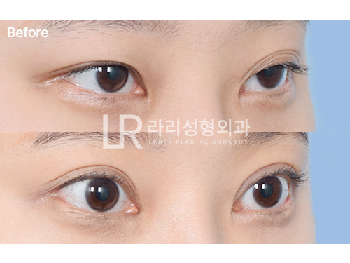 [Lari Plastic Surgery] One-Sided Loosening After Buried Double-Eyelid Surgery: Changes After Incision Revision Surgery for Multiple Eyelid Folds and Eye-Shape Correction image 6