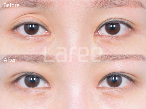 [Lari Plastic Surgery] Eyelid Fat Grafting for Improving the Eyelid Hollow: Incision Method vs. Non-Incision Method image 4