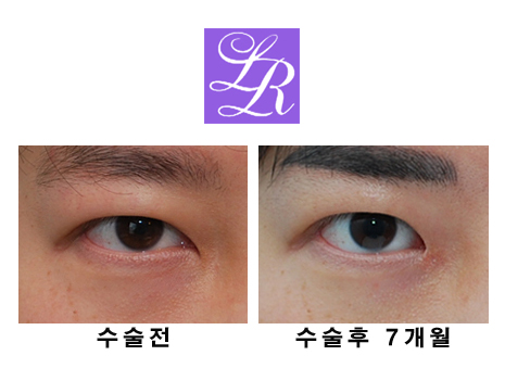 Can Epicanthoplasty Improve Facial Impression? Mongolian Fold Hook Correction image 1