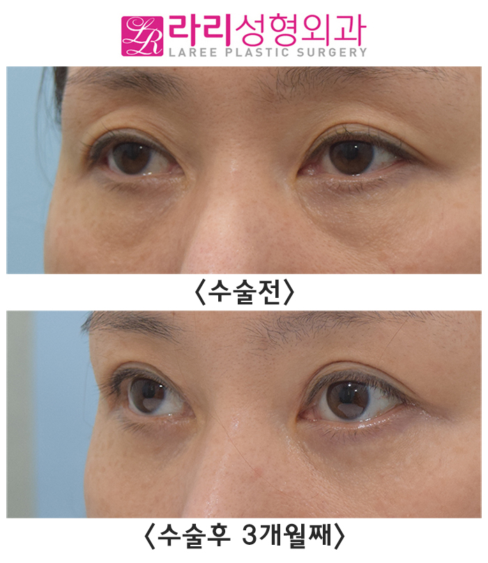 [라리성형외과] 절개눈매교정으로 윗눈꺼풀패임 개선될까?! (+ 눈밑지방재배치수술 ) 관련 이미지 1