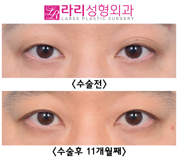 [Lari Plastic Surgery] Surgery Before-and-After Photos for Removing Multiple Eyelid Folds That Are Hard to Leave Alone image 2