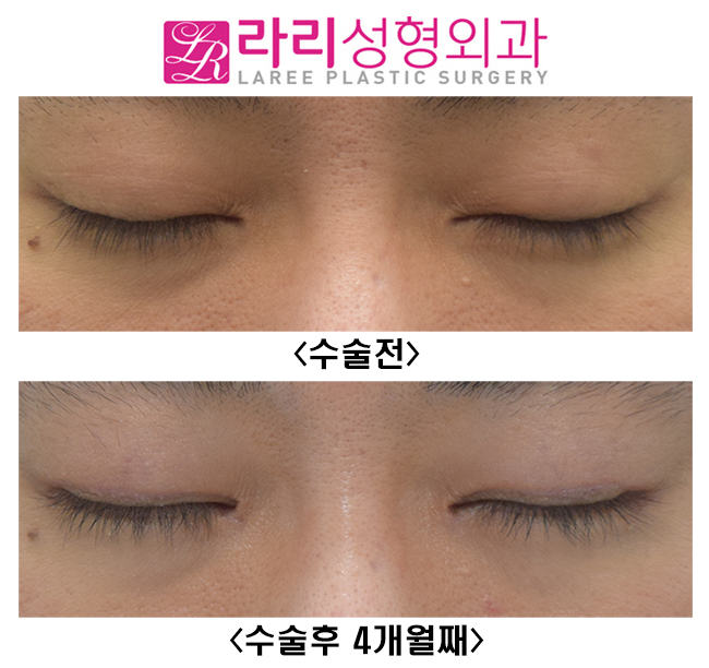 [라리성형외과] 쌍꺼풀없애는수술+ 트임없는앞트임수술+ 눈꼬리내리기뒤트임수술 = 또렷한 눈, 남자다운 눈, 멋있는 눈 관련 이미지 4