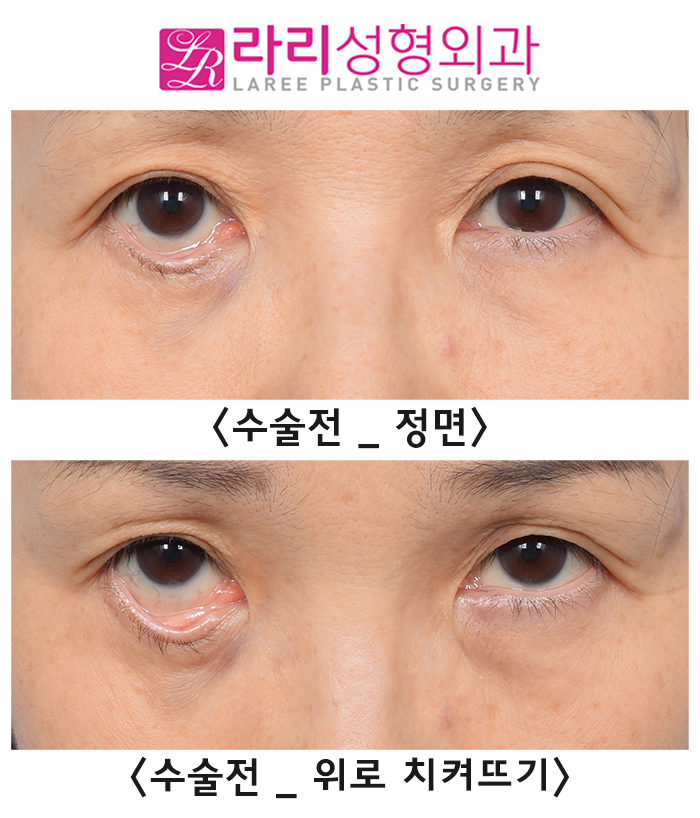 [Rari Plastic Surgery] The Most Common Complication of Lower Blepharoplasty: Lower Eyelid Ectropion image 4