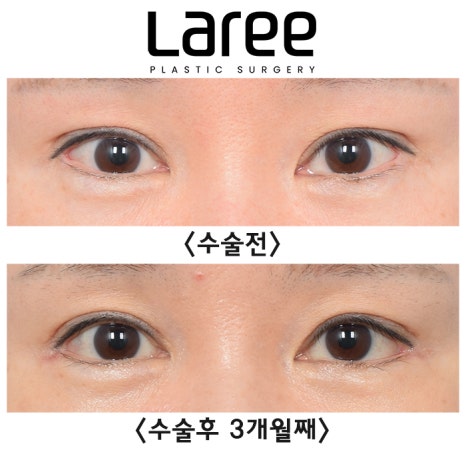 [Lari Plastic Surgery] A Collection of Various Surgeries for Double Eyelids image 5