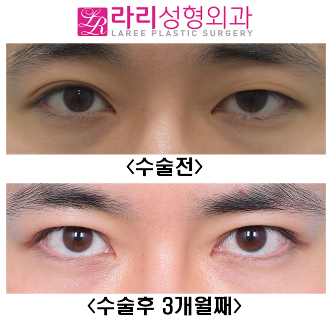 [Lari Plastic Surgery] Is it possible to have a distinct eye even with a hidden double eyelid?! (I don’t want uneven eyes) image 1