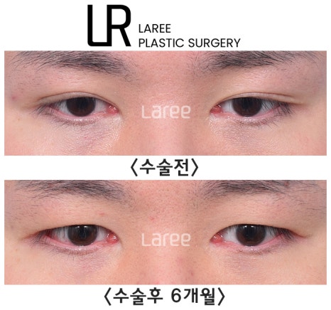 [라리성형외과] 쌍꺼풀없애는 무쌍 수술, 쌍꺼풀라인 낮추기가 아닙니다. (완전무쌍과 무쌍속쌍 그 차이) 관련 이미지 14