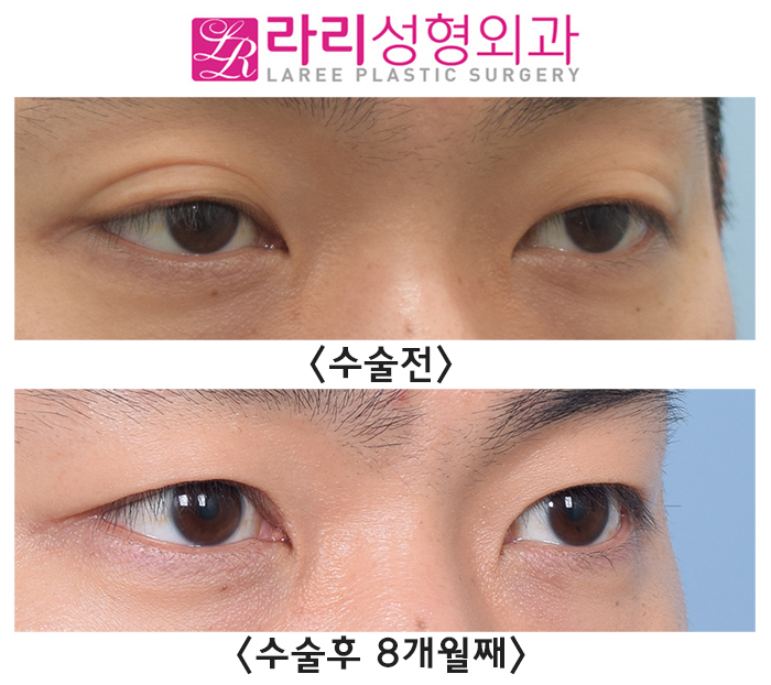 [라리성형외과] 쌍꺼풀없애는수술, 남자라면 꼭 고려해 보세요. 관련 이미지 2