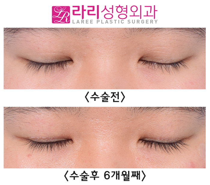 [Lari Plastic Surgery] Correcting a Severe Uneven Eye with Double Eyelid Removal Surgery image 5