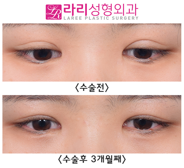 [Rari Plastic Surgery] Making Small Eyes Look Bigger with Revision Double Eyelid Surgery and Sausage Correction image 3