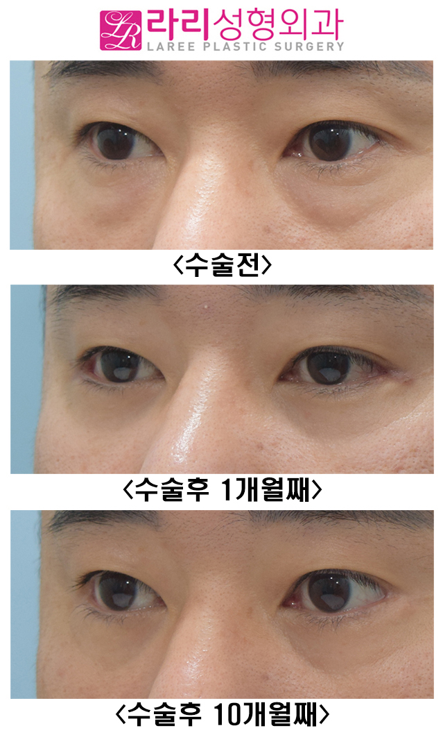 [라리성형외과] 남자 눈꼬리내리기 뒤트임수술 후 변화 관련 이미지 4
