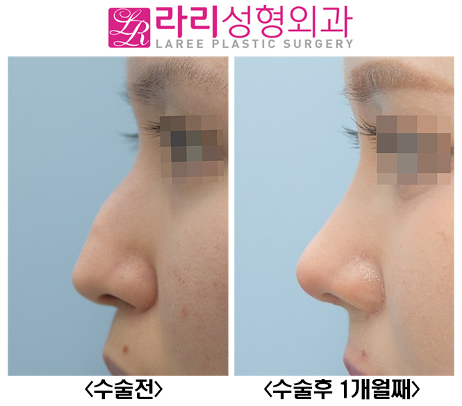 [라리성형외과] 매부리코수술, 무보형물로 자연스럽고 매끈하게 관련 이미지 5