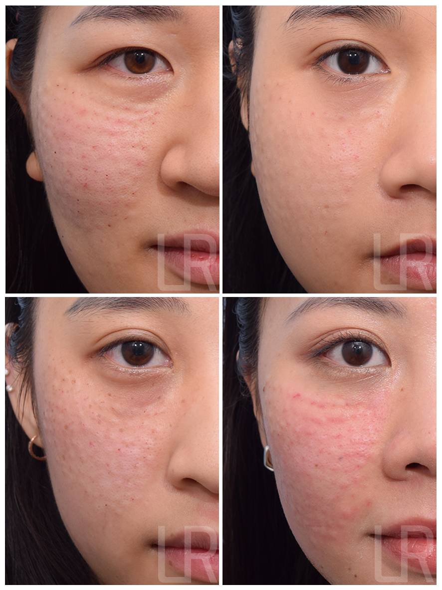 [Lari Plastic Surgery] Rejuran Treatments That Help Strengthen Your Skin’s Natural Ability to Become Healthy Begin at Lari Plastic Surgery. image 4