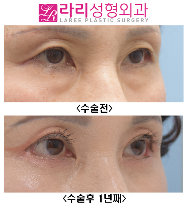[Lari Plastic Surgery] Upper eyelid surgery, non-epicanthic inner corner surgery, revision outer corner surgery, and lower eyelid fat repositioning can all be done at once. Recovery with good results is possible! image 4